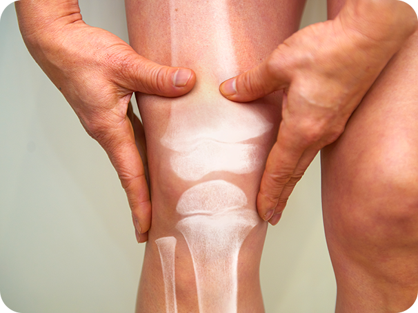 ¿Qué es la artritis reumatoide?