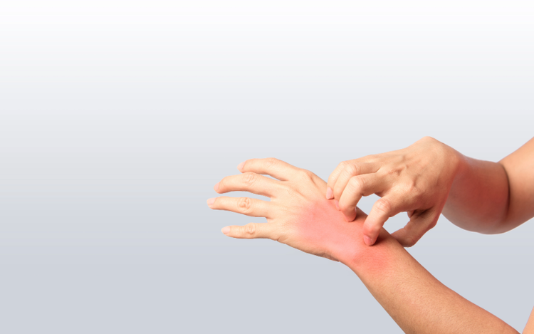 Recursos e Información de la Dermatitis Atópica