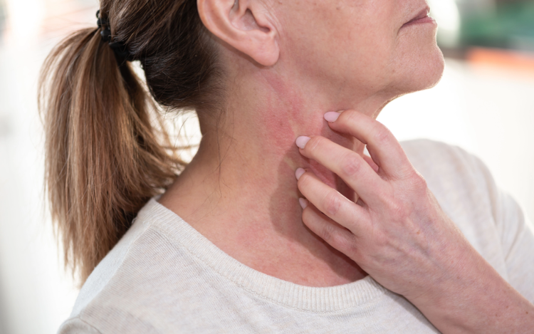 ¿Qué es la Dermatitis Atópica?