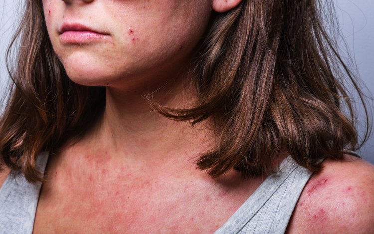 Preguntas Frecuentes sobre la Dermatitis Atópica