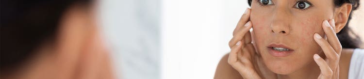 Signos y síntomas de la dermatitis atópica