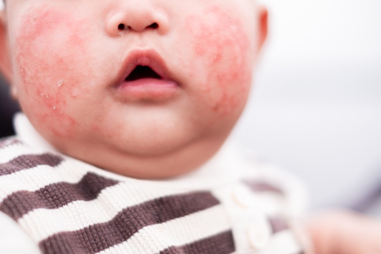 Signos y síntomas de la dermatitis