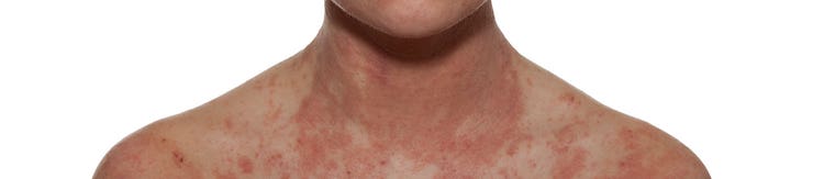¿Qué es la dermatitis atópica?