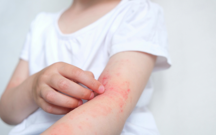Signos y Síntomas de la Dermatitis Atópica