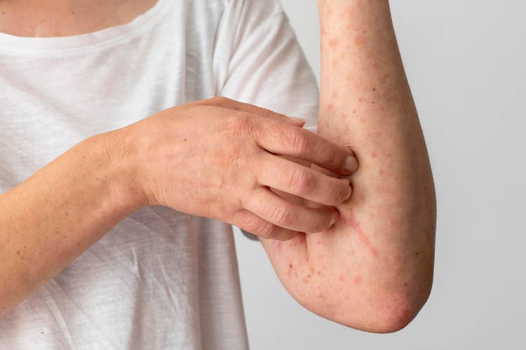 ¿Qué es la dermatitis atópica?