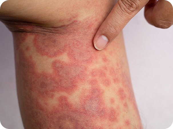 Signos y síntomas de la dermatitis atópica