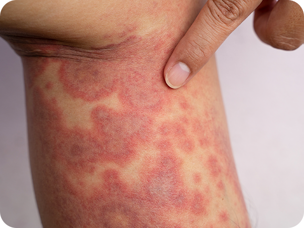 Signos y síntomas de la dermatitis atópica