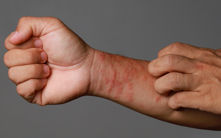 Mitos y Realidades de la Dermatitis Atópica