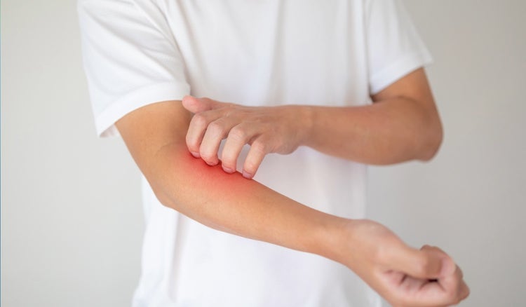 ¿Qué es la dermatitis atópica?