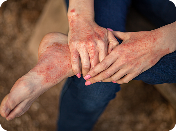 Causas de la dermatitis atópica