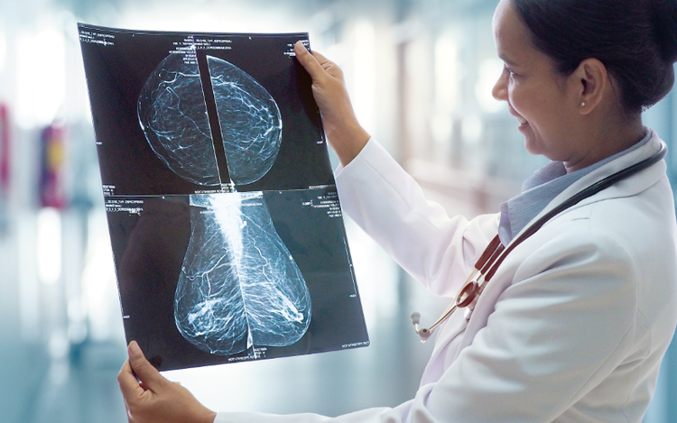 Signos y Síntomas del Cáncer de Mama