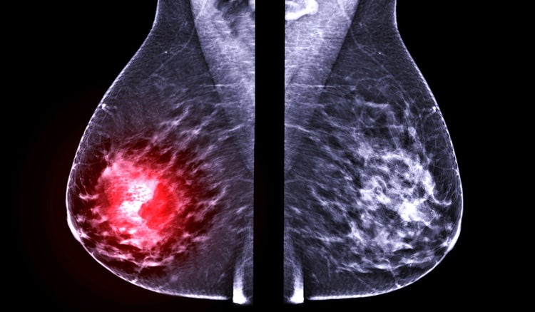 Diagnóstico y síntomas del cáncer de mama metastásico