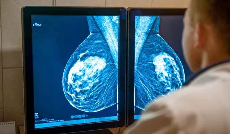 ¿Cuál es el tratamiento del cáncer de mama?
