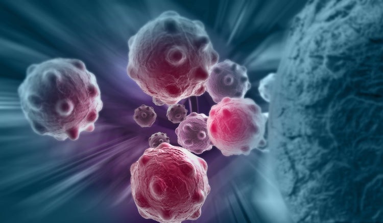 ¿El cáncer metastásico es lo mismo que el cáncer avanzado?