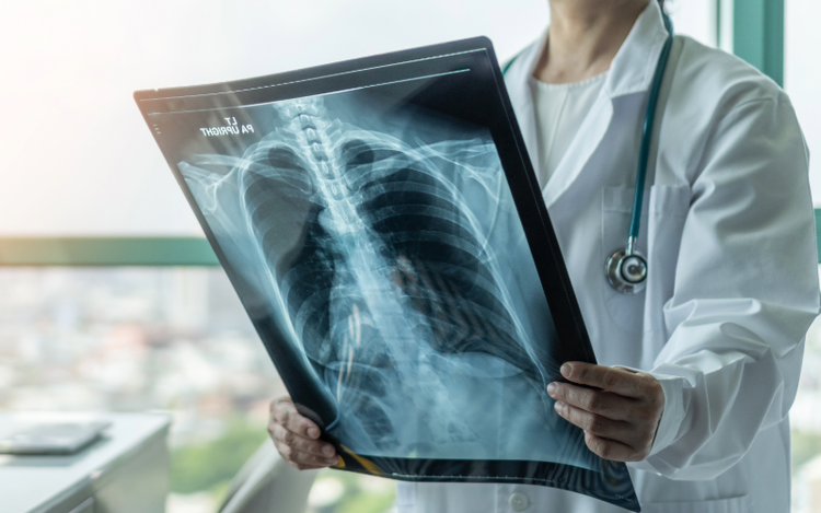 Signos y Síntomas del Cáncer de Pulmón