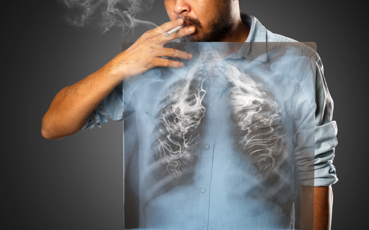 Mitos y Realidades del Cáncer de Pulmón