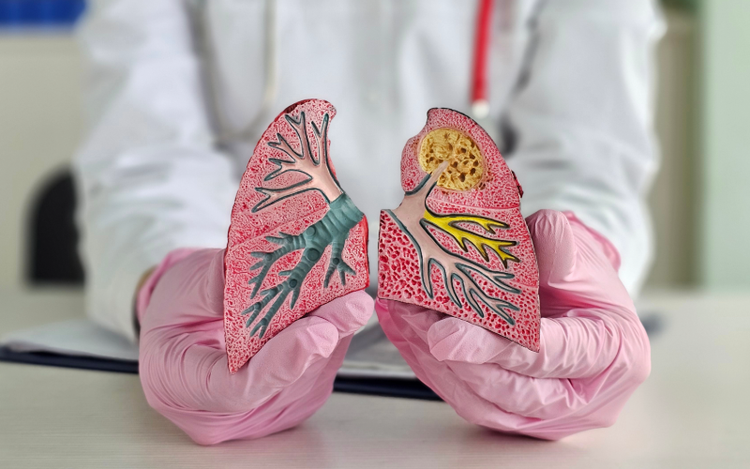 Cáncer de Pulmón