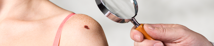 Melanoma