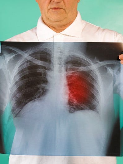 Cáncer de Pulmón