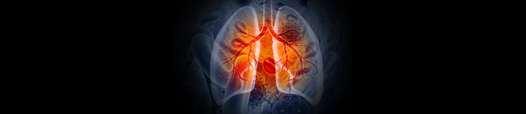 Cáncer de pulmón