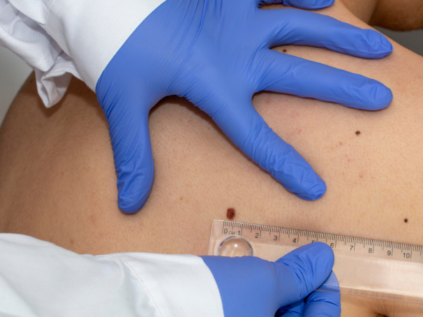 Signos y síntomas del melanoma