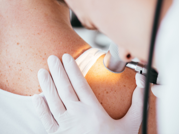 ¿Qué es el melanoma?