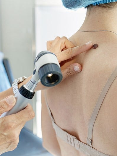 Melanoma