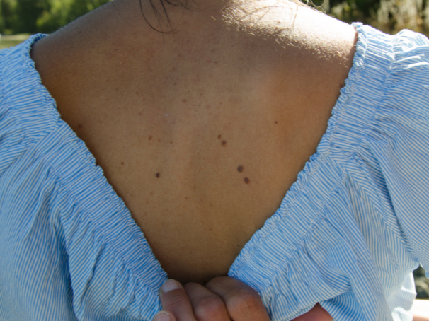 Preguntas frecuentes del melanoma