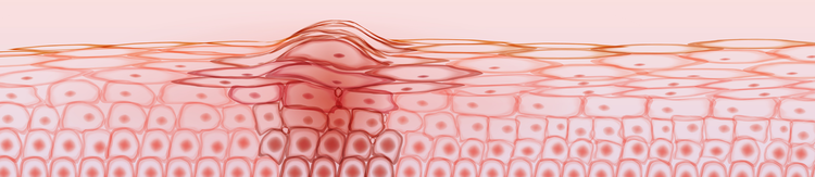 Signos y síntomas del Melanoma