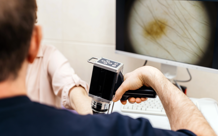 Sobre el Melanoma