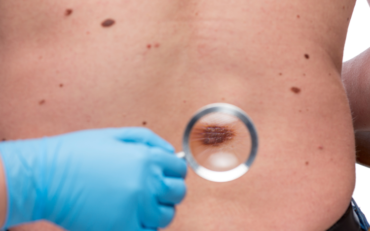 Preguntas Frecuentes sobre el Melanoma