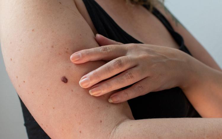 Mitos y Realidades del Melanoma