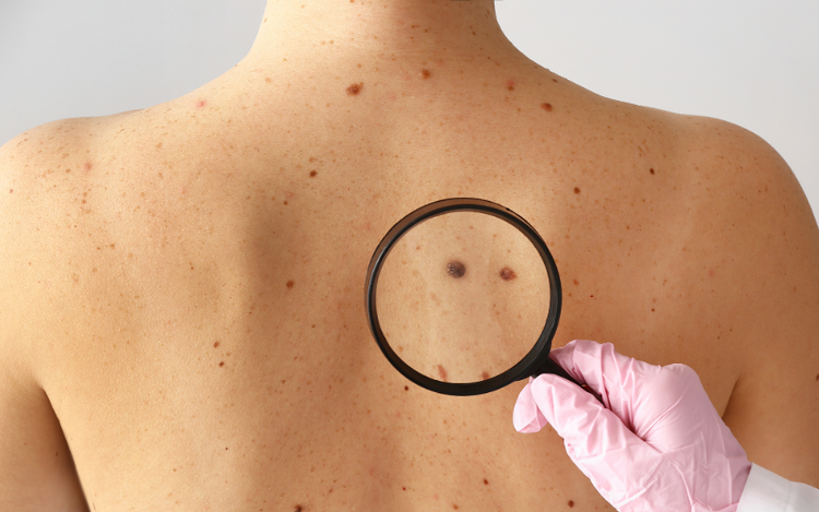 Melanoma
