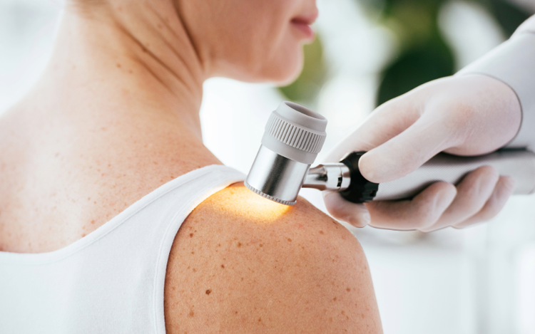 ¿Qué es el Melanoma?