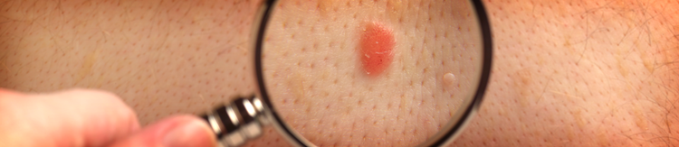 ¿Qué es el Melanoma?