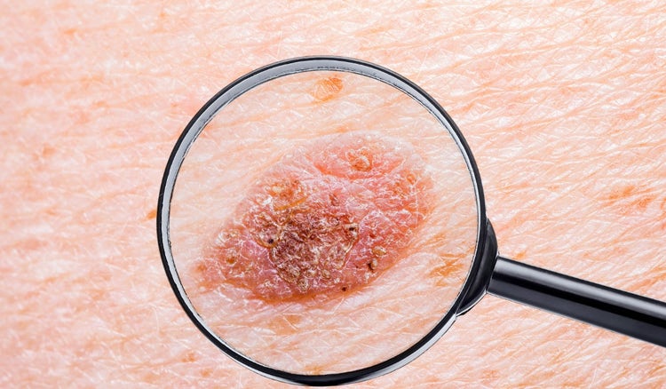 5 señales de alerta del melanoma (cáncer de piel)