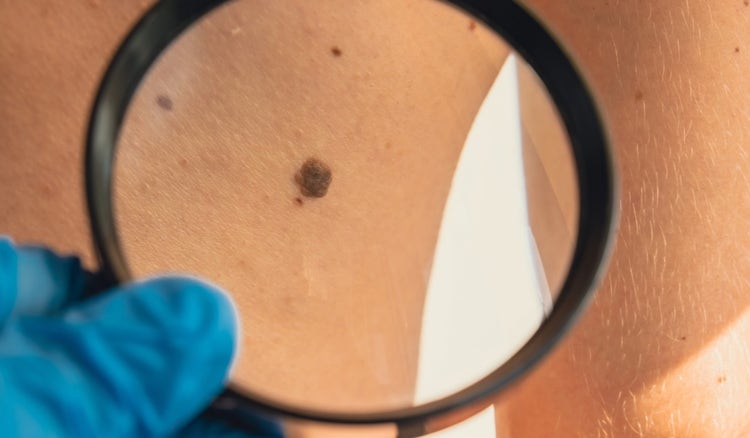 ¿Cómo prevenir el cáncer de piel (melanoma)?