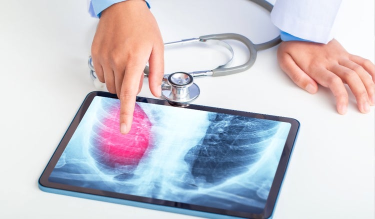 Diferencias clave entre bronquitis y neumonía