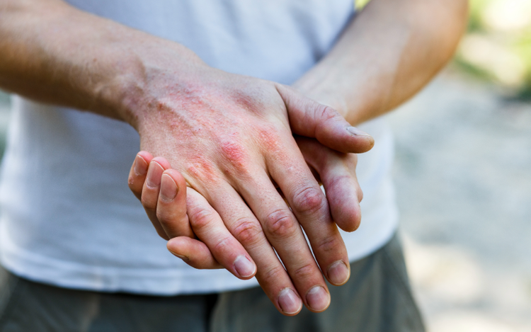 Enfermedades Dermatológicas